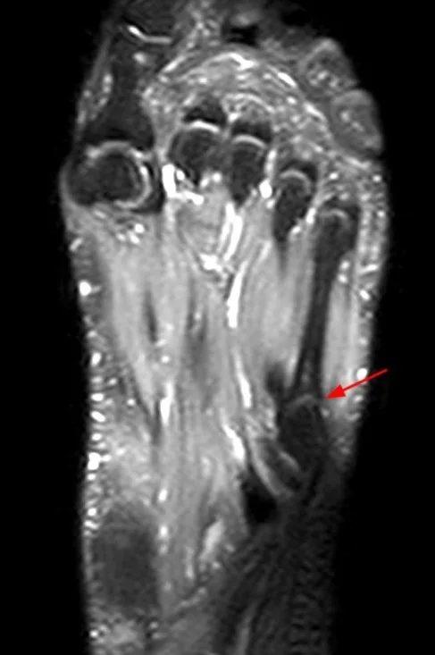 jalkapöydänluun rasitusmurtuma näkyy hyvin magneetissa (MRI)