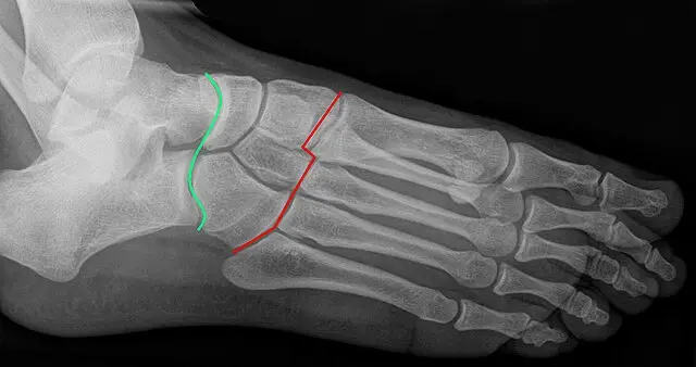 Chopart-nivelen anatomia kaavamaisessa röntgenkuvassa.Nivelrikko on seurausta mikäli alueen vammat jäävät hoitamatta.