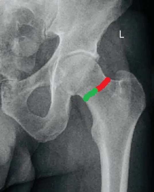 femur neck stress fractures