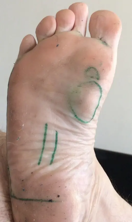 Ledderhosen plantar fibromatosis