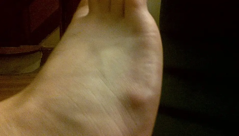 ganglion