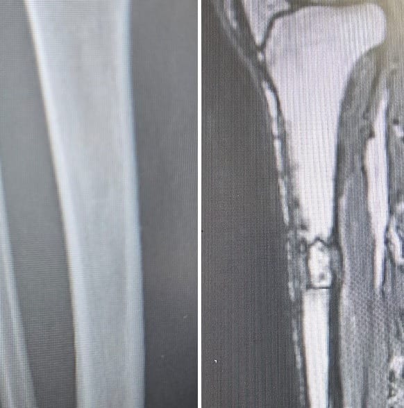 Luutumaton murtuma (Non-union) – Diagnostiikka ja moderni hoito 1 Luutumaton murtuma (nonunion) voi olla vaikeasti hoidettavissa. Kuvassa luutumaton murtuma Röntgen- ja magneettikuvassa.