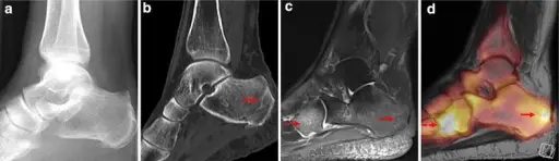Kantaluun rasitusmurtuma - Alidiagnosoitu kantapään kivun syy 1 Kantaluun ja kuutioluun murtumat näkyvät hyvin MRI-tutkimuksessa. Rasitusmurtuman diagnostiikassa MRI on ensisijainen.
