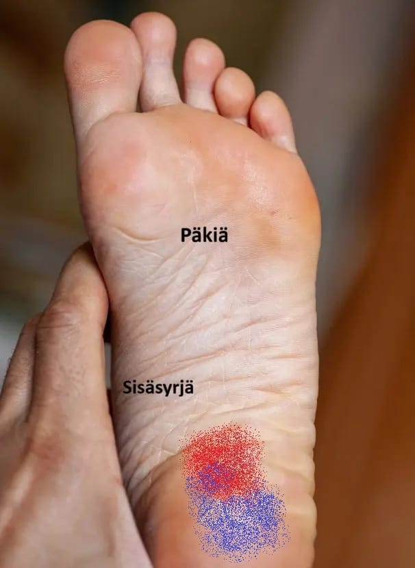 Kantapään rasvapatjan oireyhtymä. Kipu tuntuu kantapäässä hieman taaempana kuin plantaarifaskiitissa.
