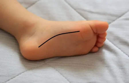 Asiantuntija-artikkelit 76 Mediaalinen holvikaari. Tällä alueella voi oireilla mm. plantaarifaskia, os tibiale externum, tibialis posterior, intetsektiosyndrooma/FHL, Veneluu, mediaalinen cuneiforme, talonaviculare-nivel