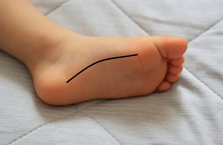 Tibialis posterior jänteen ongelmat (PTDD) 1 Kuva lättäjalasta, missä näkyy pitkittäisen holvin laskeutuminen. Aikuisen lattajalka eroaa synnynnäisestä lättäjalasta ja siinä oireena on nilkan sisäsyrjän kipu