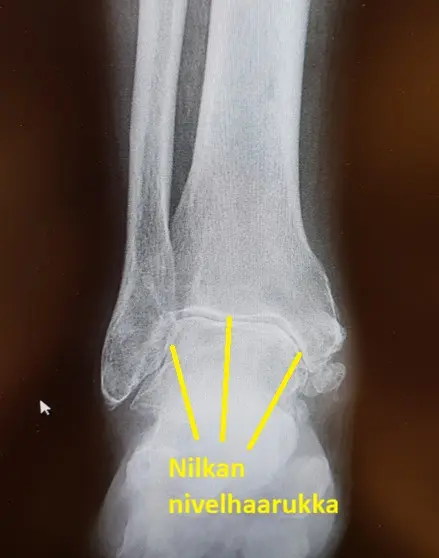Nilkan Nivelrikko artroosi Nilkkavammojen Seuraus 