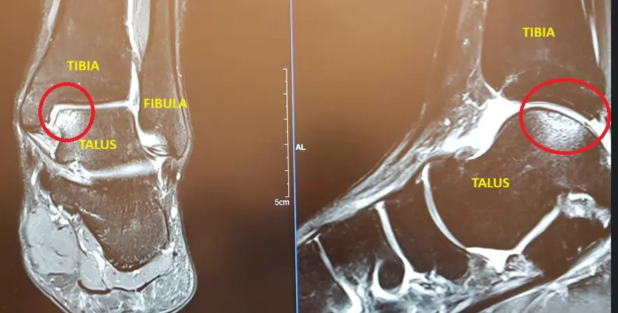 Nilkan rustovaurio (ocd / ocl) - Oireet, tutkimukset ja hoito. 2 Nilkan rustovaurio (OCD / OCL) MRI (magneettikuva).