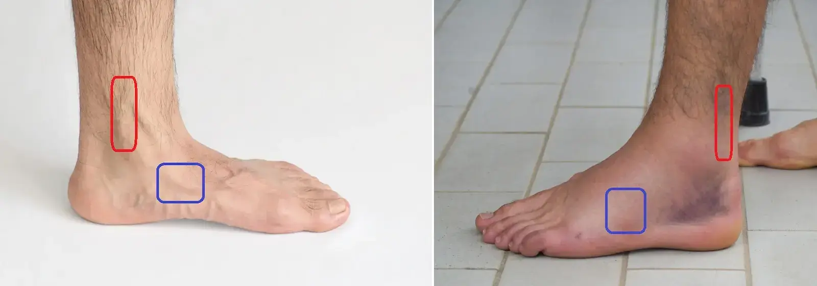 Ottawa ankle rules akuutin nilkkavamman kohdalla helpottaa diagnoosin tekoa