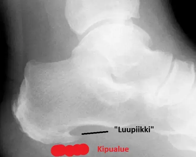 Plantaarifaskiitti eli "luupiikki" tuntuu kantapääkipuna varsinkin aamun ensimmäisillä askeleilla.