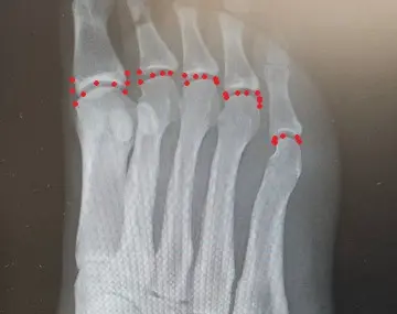 Plantar plate -vaurio Päkiän kipu ja yksi vasaravarpaan syy 1 Plantar plate -vaurio tulee varpaan tyviniveleen päkiän puolelle