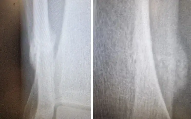 Pohjeluun rasitusmurtuma – Säären ulkosyrjän kivun syyt ja 3-osainen hoito. 1 Pohjeluun (fibula) alaosan parantunut rasitusmurtuma röntgenkuvassa F-ESWT-hoidon jälkeen.