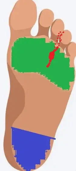 Mortonin neurooma – Päkiän 1. hermopinne ja sähköiskumaisen kivun hoito 1 Mortonin neurooma on yleisin jalan hermopinne. Kuva demonstroi hermon kulun ja neurooman sijainnin