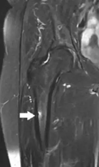 Reisiluun patologinen murtuma, osteoporoosilääke haitat