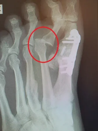 Asiantuntija-artikkelit 108 Plantar plate -vaurion huomaa siitä, että varpaan tyvinivel menee pois paikoiltaan