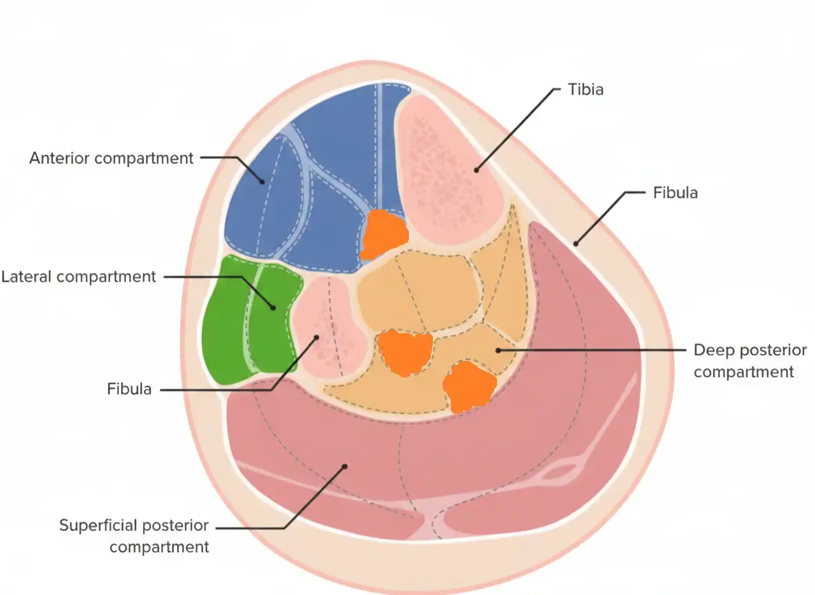 Säären aitio-oireyhtymä (Compartment Syndrome) – Kun lihaksen tila loppuu kesken 2 Aitio-oireyhtymä. Kaaviokuva säären poikkileikkauksesta, jossa näkyvät säären neljä lihasaitiota (etuaitio, ulkoaitio, syvä ja pinnallinen taka-aitio) sekä niitä ympäröivät joustamattomat peitinkalvot.
