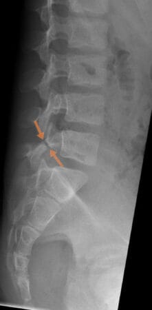 Asiantuntija-artikkelit 18 Pars-murtuma eli spondylolyysi nuorella urheilijalla
