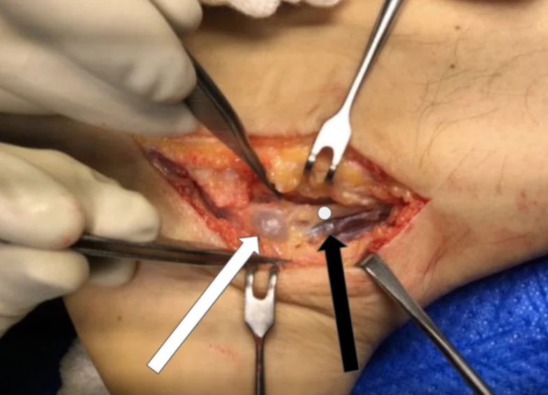 Tarsaalitunnelisyndrooma – Nilkan hermopinne, tutkimukset ja hoito 4 tarsal tunnel syndrome vargas 2022 oper
