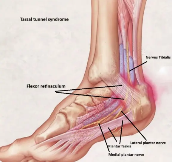Tarsaalitunnelisyndrooma – Nilkan hermopinne, tutkimukset ja hoito 2 tarsal tunnel syndrooma nilkka sisasyrja