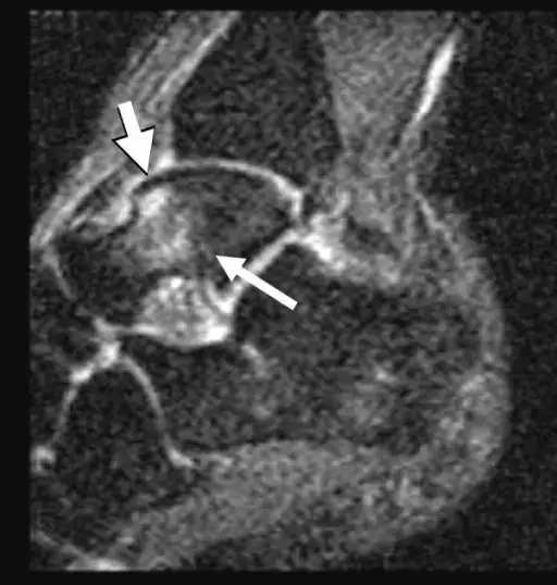 Telaluun (talus) rasitusmurtumat ja niiden esiasteet (rasitusosteopatia) näkyvät hyvin MRI-kuvassa.