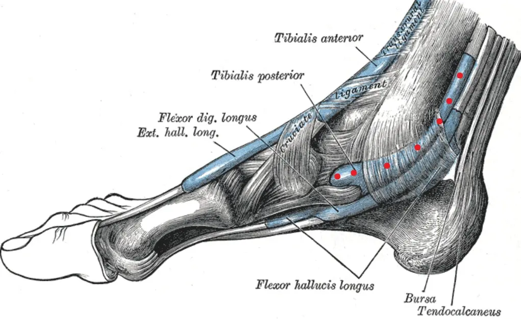 Tibialis posterior jänteen ongelmat (PTDD) 2 ibialis posterior -jänne tukee jalan sisäsyrjää.