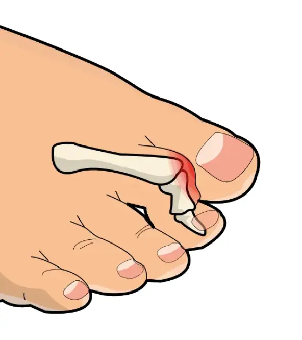 Vasaravarvas, koukkuvarvas ja nuijavarvas – 2. - 5. varpaiden virheasennot 8 Vasaravarvas eli hammer toe